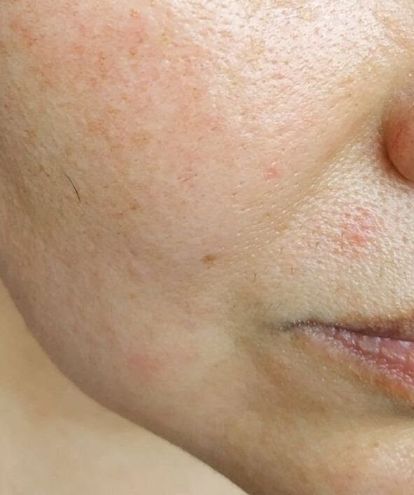 Intenskin got rid of the deep nasolabial folds